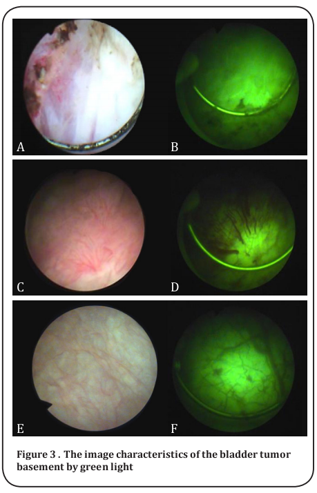 Figure 3 . The image characteristics of the bladder tumor 
basement by green light