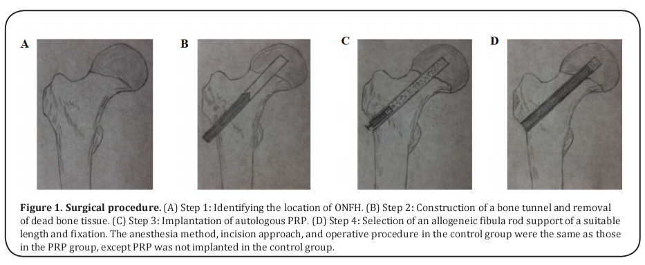 Figure 1. Surgical procedure. 