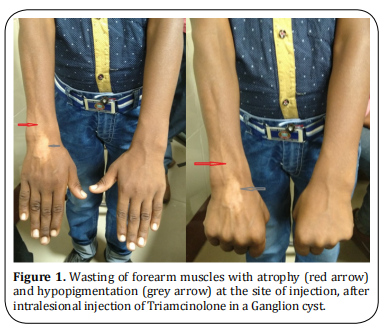 Hypopigmentation with muscular and subcutaneous atrophy as a complication of Intralesional ...