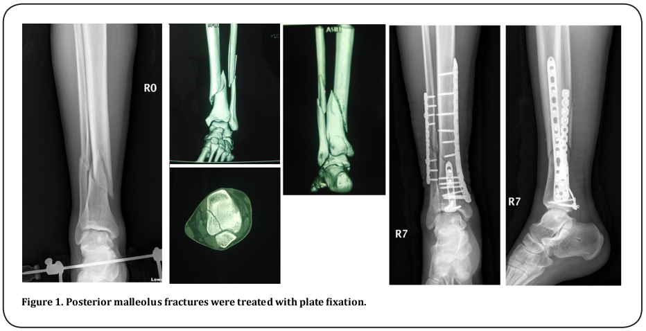 Figure 1. Posterior malleolus fractures were treated with plate fixation. 