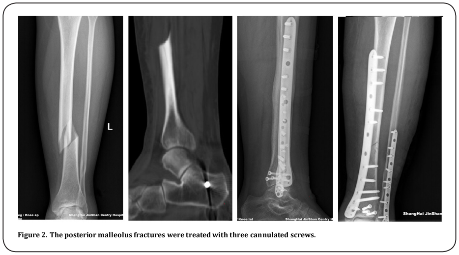 Figure 2. The posterior malleolus fractures were treated with three cannulated screw