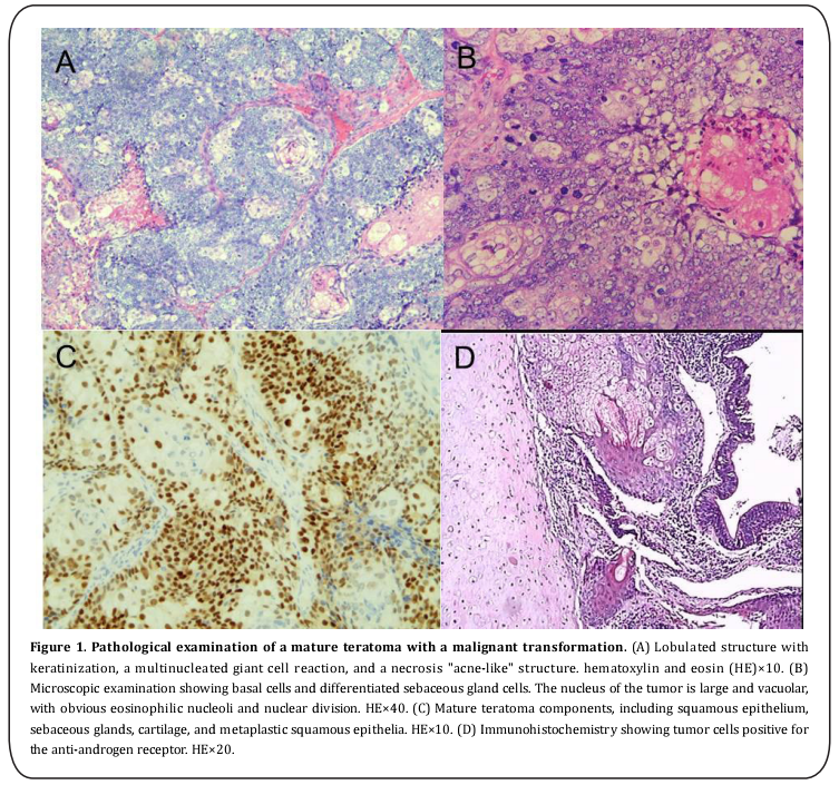 Figure 1. Pathological examination of a mature teratoma with a malignant transformation. 
